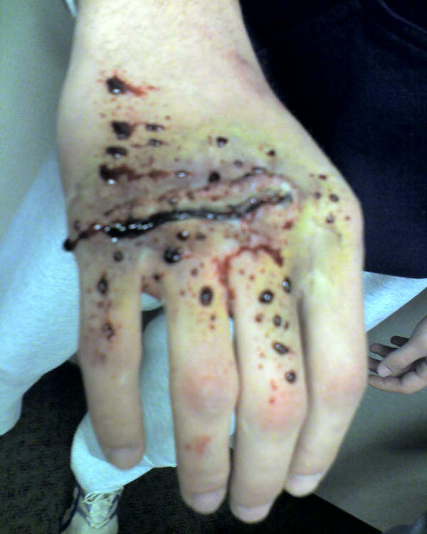 Hand Laceration by